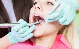 Разновидности зубного камня и методы его удаления