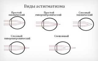 Астигматизм и близорукость в чем отличие, лечение и профилактика