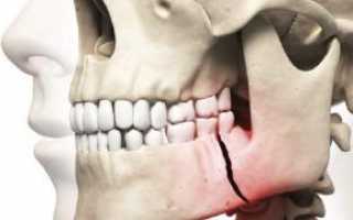 Открытый перелом челюсти: что нужно знать о травме