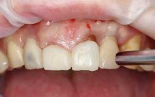 Что выбрать для замены зуба — штифт или дентальные импланты?
