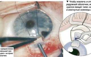 Как происходит трабекулэктомия при глаукоме?