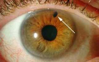 Как развивается пигментная глаукома — методы борьбы с ней