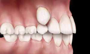 Множество лишних зубов при гипердонтии