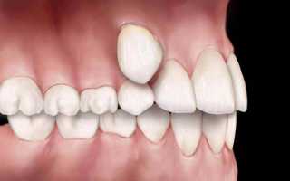 Множество лишних зубов при гипердонтии