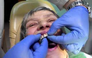 Какие современные зубные протезы самые надежные?