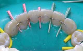 Материалы и виды шинирования зубов