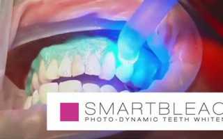 10 преимуществ отбеливания зубов методикой Smartbleach