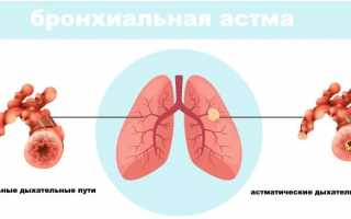 Бронхиальная астма: виды, причины, лечение