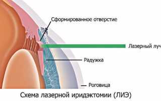 Лазерная иридотомия при глаукоме – особенности проведения операции