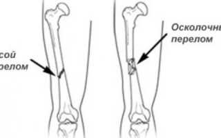 Оскольчатый перелом бедра со смещением: симптомы и лечение