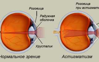 Что такое астигматизм — симптомы, причины, как лечить?