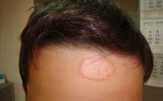 Микоз гладкой кожи: код МКБ-10, фото симптомов, особенности лечения