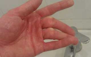Перелом среднего пальца руки: внутрисуставный или краевой