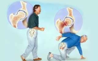 Перелом бедренного сустава: причины и симптомы