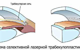 Как проводится лазерная трабекулопластика при глаукоме?