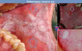 4 типа лейкоплакии полости рта