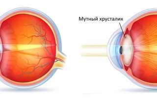 Что такое катаракта и как ее лечить?