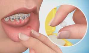 Применение ортодонтического воска для брекетов