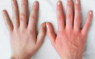 Обморожение рук: признаки и неотложное лечение