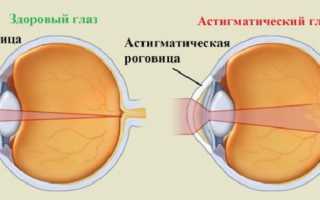 Астигматизм после замены хрусталика глаза при катаракте: осложнения после операции