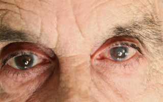 Лечение глаукомы у пожилых людей: особенности и диагностика