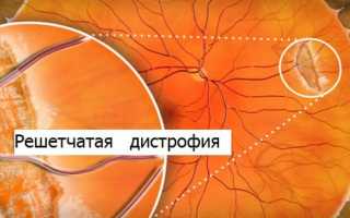 Дистрофия сетчатки глаза: виды, причины и методы лечения