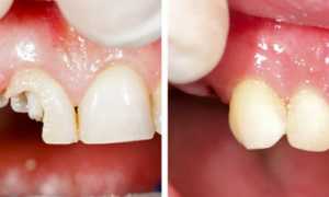 Использование зубных штифтов в стоматологии