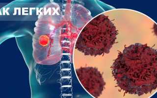Рак легких — причины, симптомы и лечение