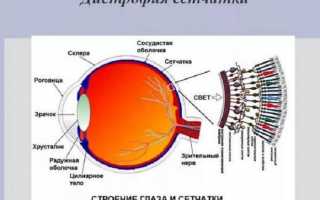 Уколы в глаза при дистрофии сетчатки: диагностика и лечение