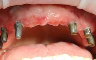 Этапы протезирования на имплантах зубов