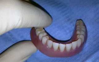 Что может вызвать аллергию на зубные протезы?