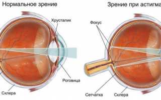 Лечение астигматизма в домашних условиях: методы без операции, народные средства