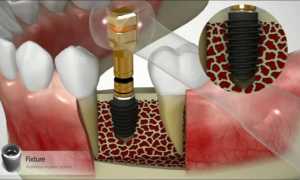 Обзор премиальных зубных имплантов AnyRidge