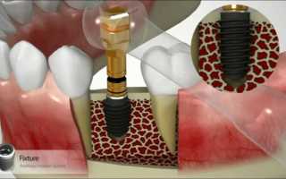 Обзор премиальных зубных имплантов AnyRidge