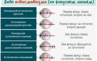 Гимнастика для глаз при астигматизме: полный комплекс упражнений