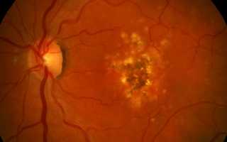 Макулярная дистрофия сетчатки глаза: лечение и диагностика