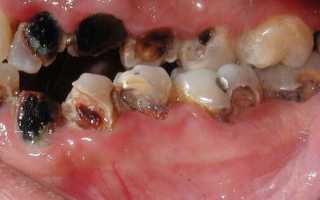 Последствия гнилых зубов для здоровья