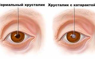 Как диагностируют катаракту — методика определения