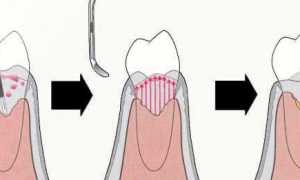 Особенности кюретажа в стоматологии