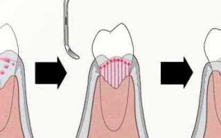 Особенности кюретажа в стоматологии