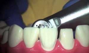Препарирование зубов — подготовка к установке виниров