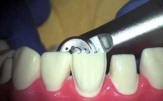 Препарирование зубов — подготовка к установке виниров