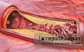 Атеросклероз: симптомы, причины, лечение