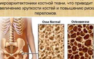 Патологический перелом бедренной кости: основные причины