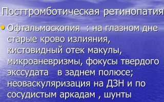 Посттромботическая ретинопатия: признаки и эффективные методы лечения