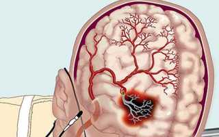 Признаки нарушения мозгового кровообращения при шейном остеохондрозе