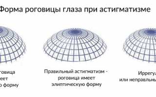 Смешанный астигматизм — что это, причины возникновения и лечение