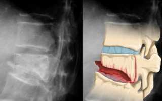 Перелом грудного отдела позвоночника: диагностика и лечение