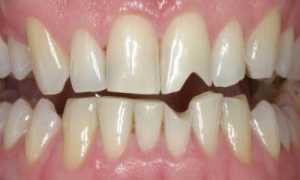 15 причин отколотого зуба