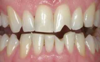 15 причин отколотого зуба